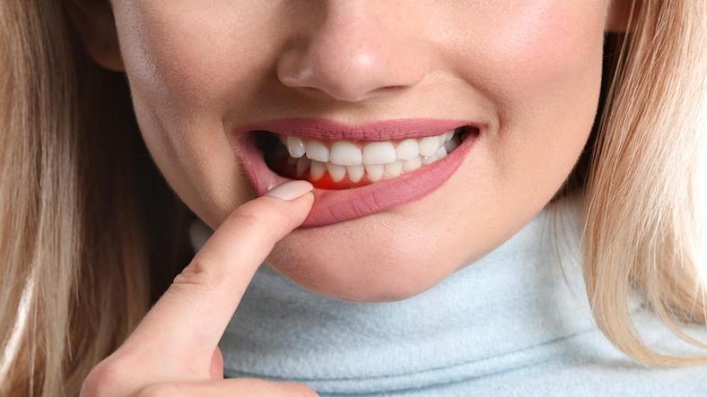 Bleeding gums, bleeding mouth facts