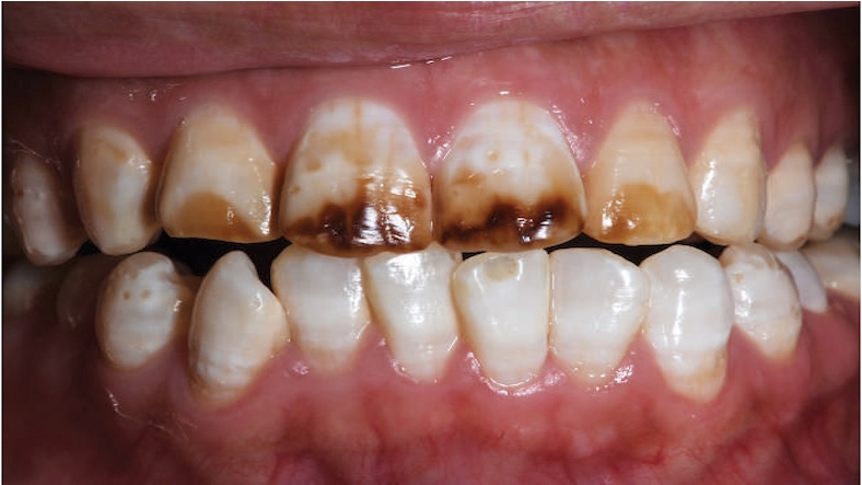 Dental Fluorosis: Types, Prevention, and Treatments