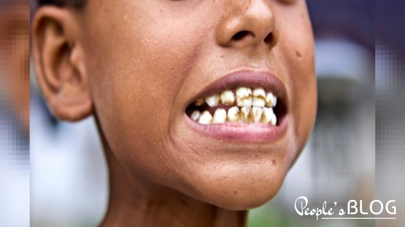 Dental Fluorosis: Types, Prevention, and Treatments