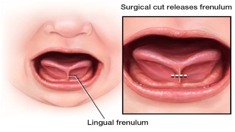 Have you noticed Tongue Tie in children?