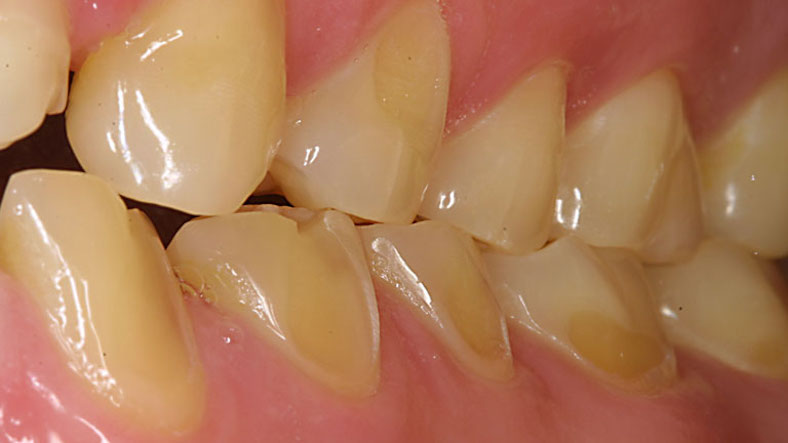 Have you observed Dental Erosion in your Teeth?