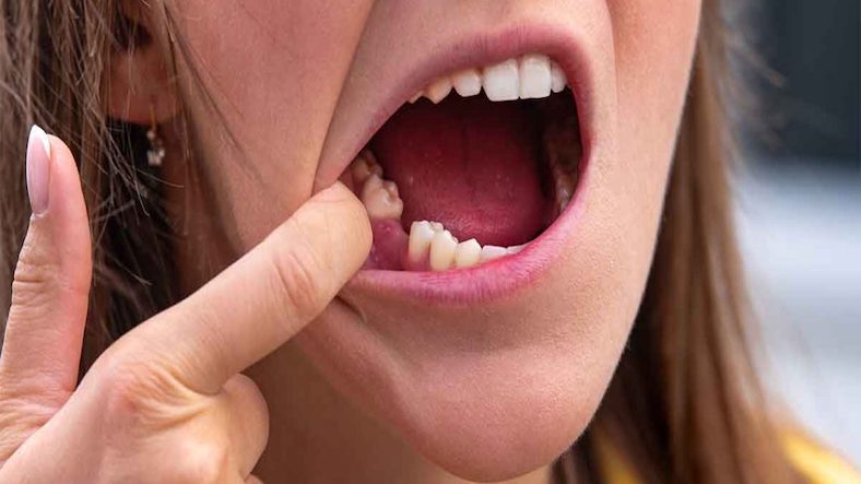 If you lose or remove your teeth, what to do next?