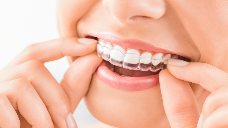 Why do dentists suggest Clear aligners (invisalign)?