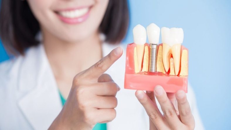 Questions to ask Dentist before Dental Implant