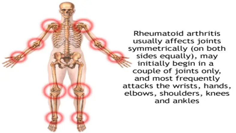 Rheumatoid Arthritis - Symptoms, Causes, Diagnosis, Treatment, Recovery