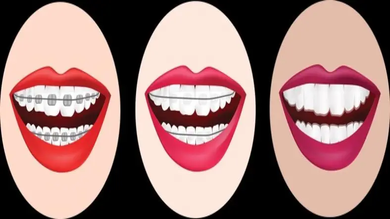 Understanding the Different Types of Braces