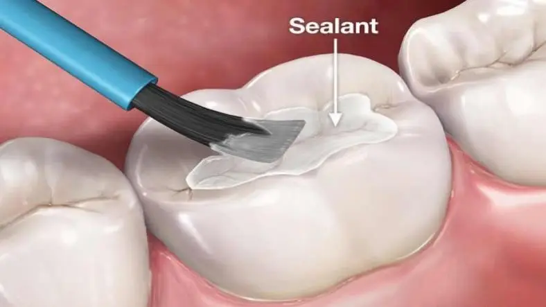 Understanding the Need for Dental Sealants