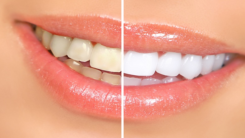 What are the reasons for yellow teeth?