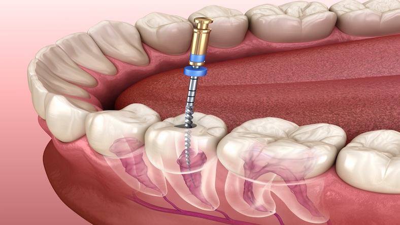 What is the need of Root Canal Treatment?