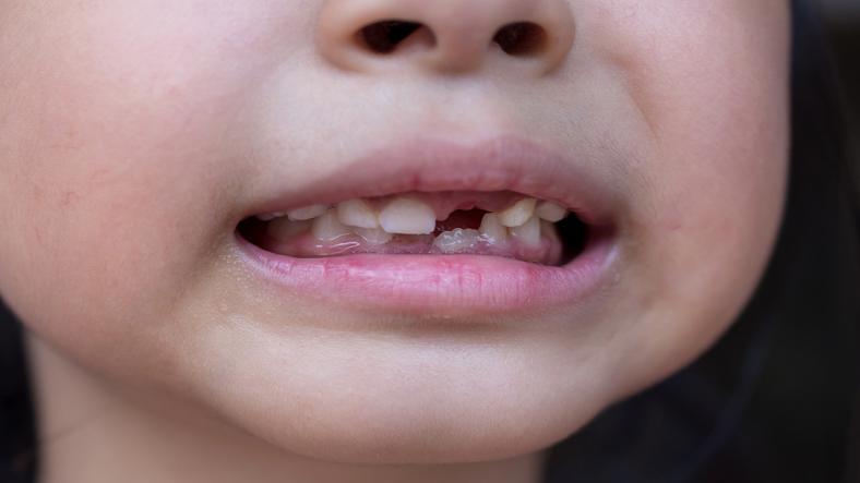 What to do when your kid's teeth are broken?