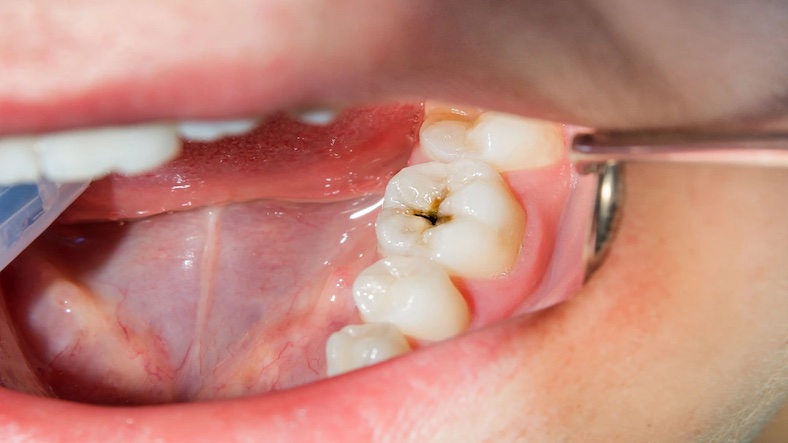 What to do with dark cavities on teeth?