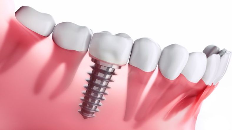 Why Dental Implants?